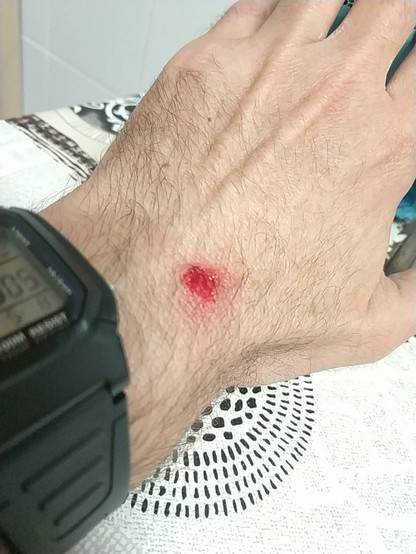 La imagen muestra el dorso de una mano con una herida superficial y enrojecida.