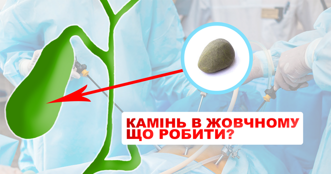 Жовчний міхур