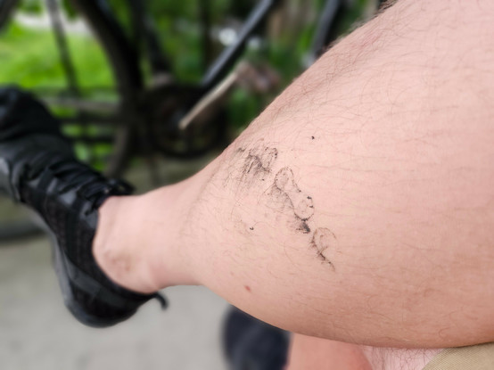 greasy bicycle chain imprint on calf.