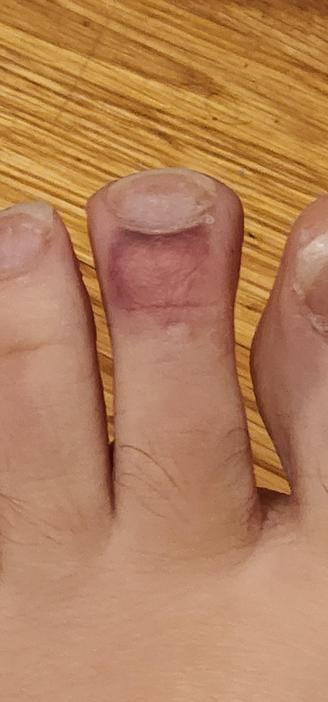 Middle toe with bruising in the area immediately behind the toenail.