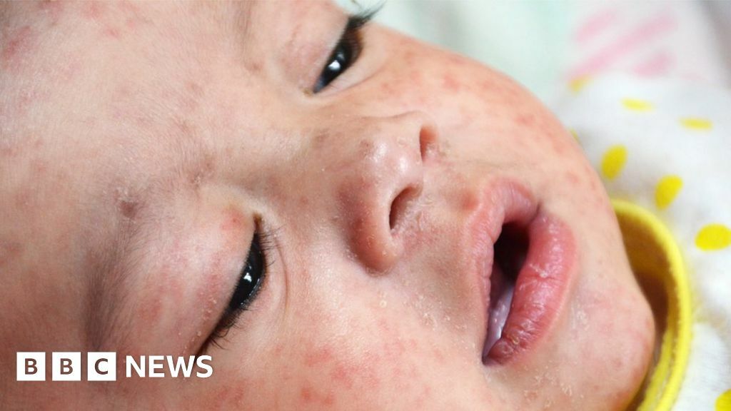 baby with measles