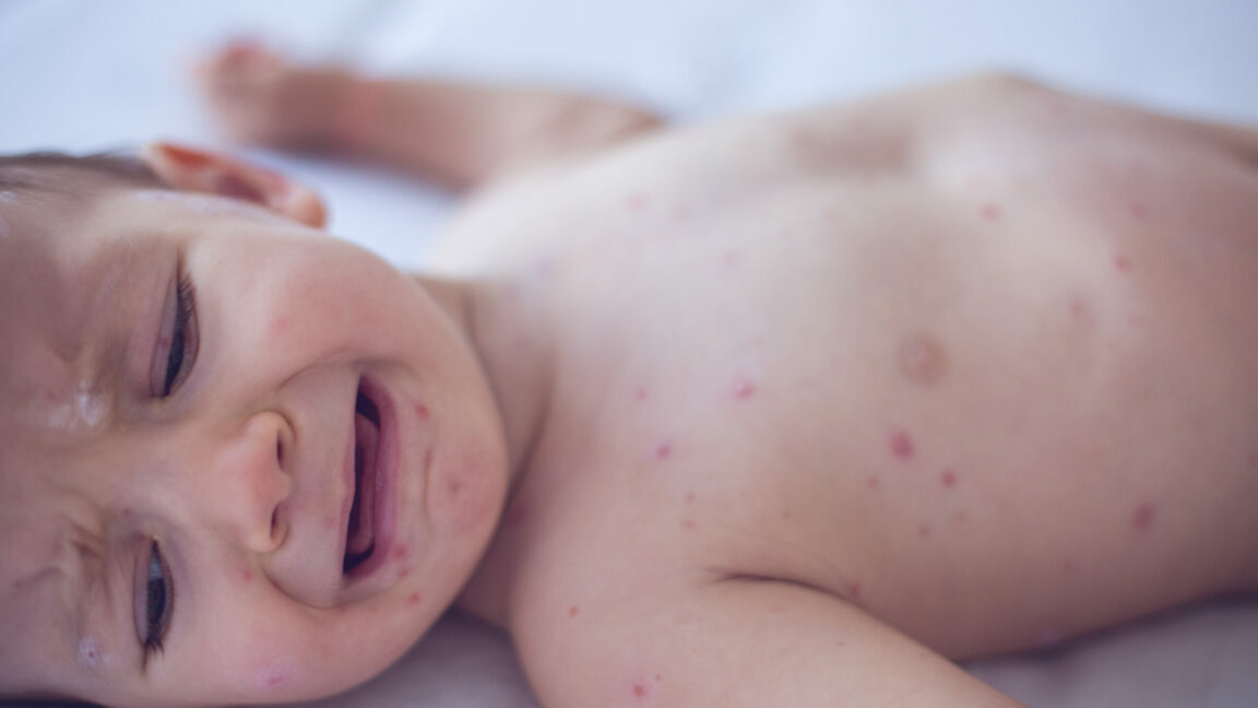 Crying baby girl with measles