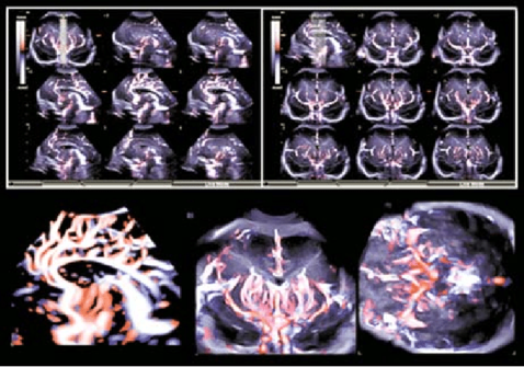 Multiple images show false-colour blood flow of sections of a living brain, displayed as slices. The ultrasound images are greyscale with  overplayed blood flow in yellows and orange tones. 