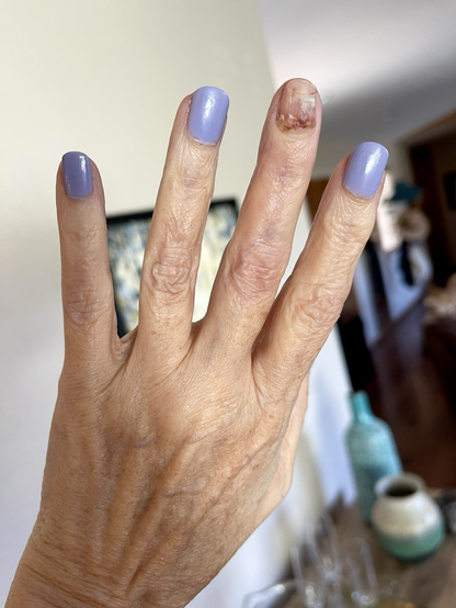 Photo of my left hand held up in the light showing 3 periwinkle blue manicured nails &  1 mangled nail with dried blood, etc., under it. It looks awful. The middle finger itself is still a little discolored & swollen, too.