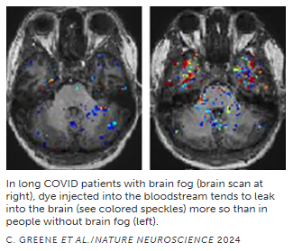 In long COVID patients with brain fog (brain scan at right), dye injected into the bloodstream tends to leak into the brain (see colored speckles) more so than in people without brain fog (left).
C. GREENE ET AL./NATURE NEUROSCIENCE 2024
