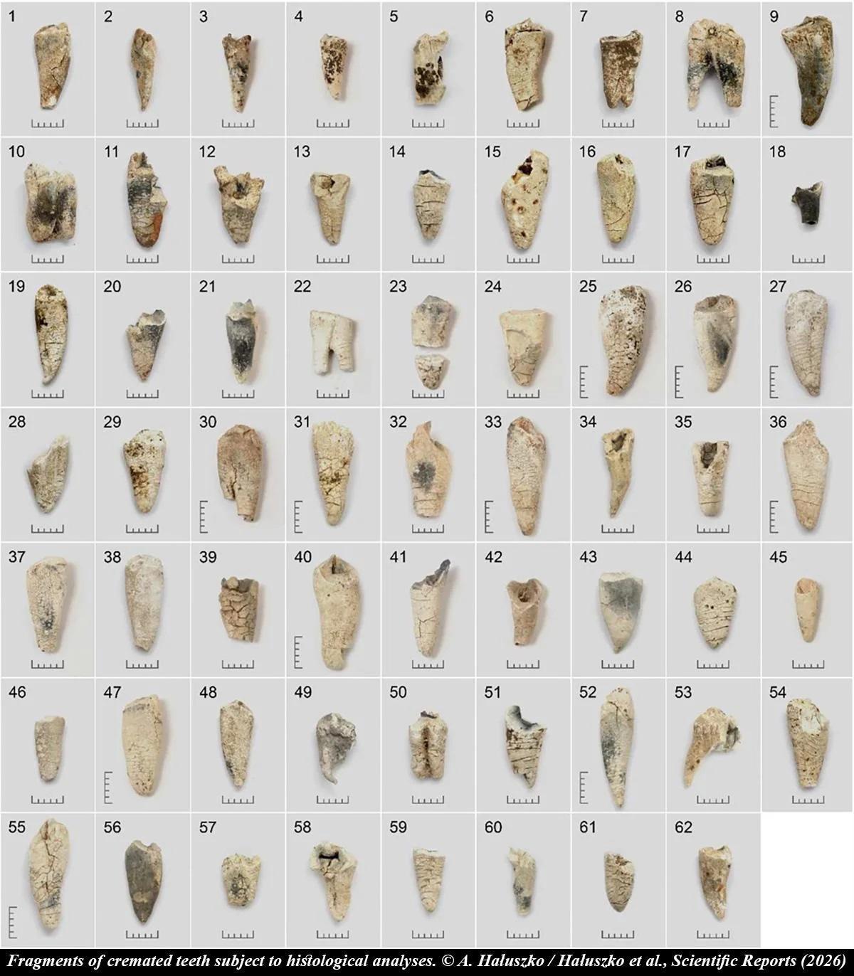 Bronze Age cremated teeth help researchers estimate age at death, study finds